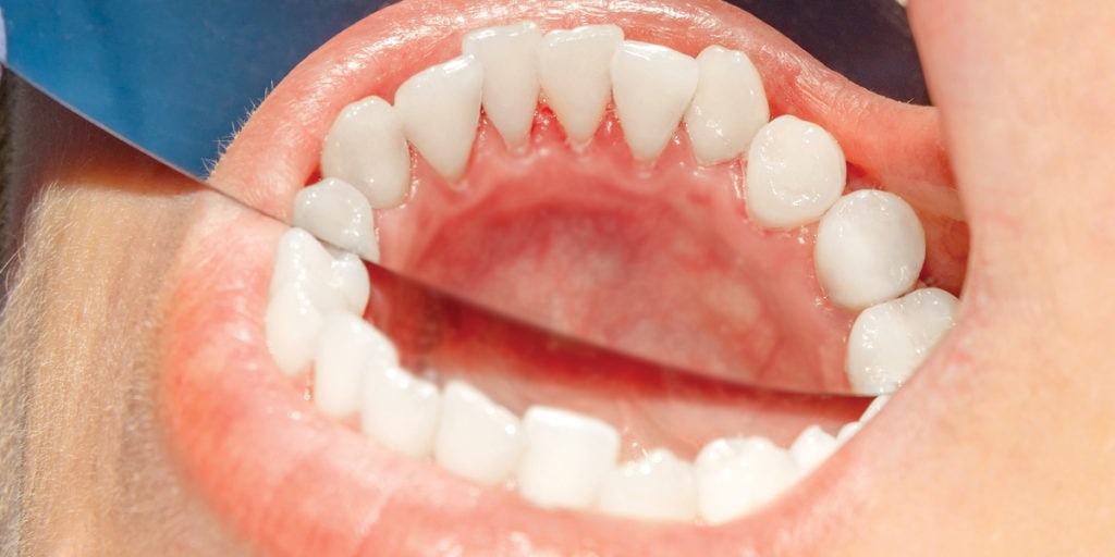 Gum Graft: Before And After 2