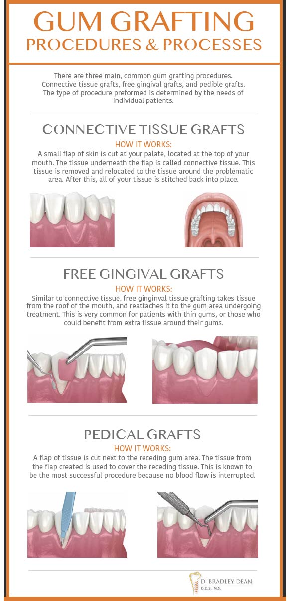 Gum Graft: Before And After 3