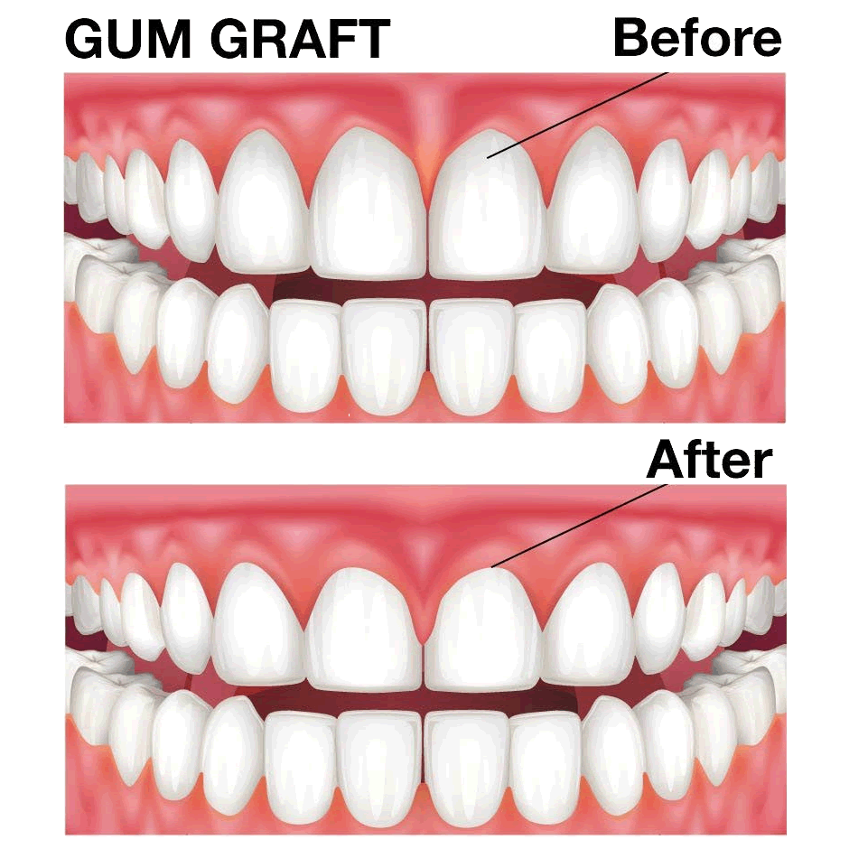 Gum Graft: Before And After 1